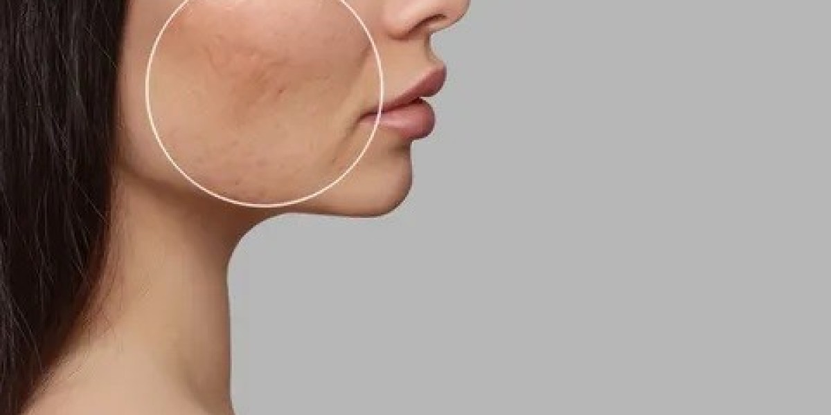 Acne Scar in Islamabad: Tips for Dry Skin.