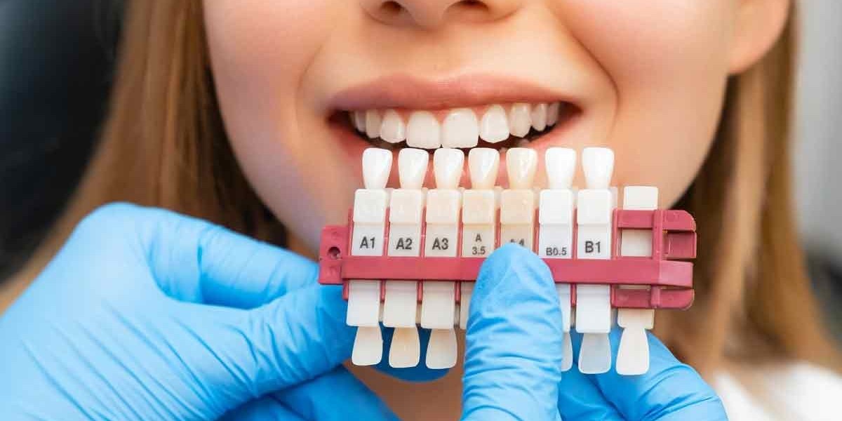 Dental Veneers Technology for Flawless Smiles