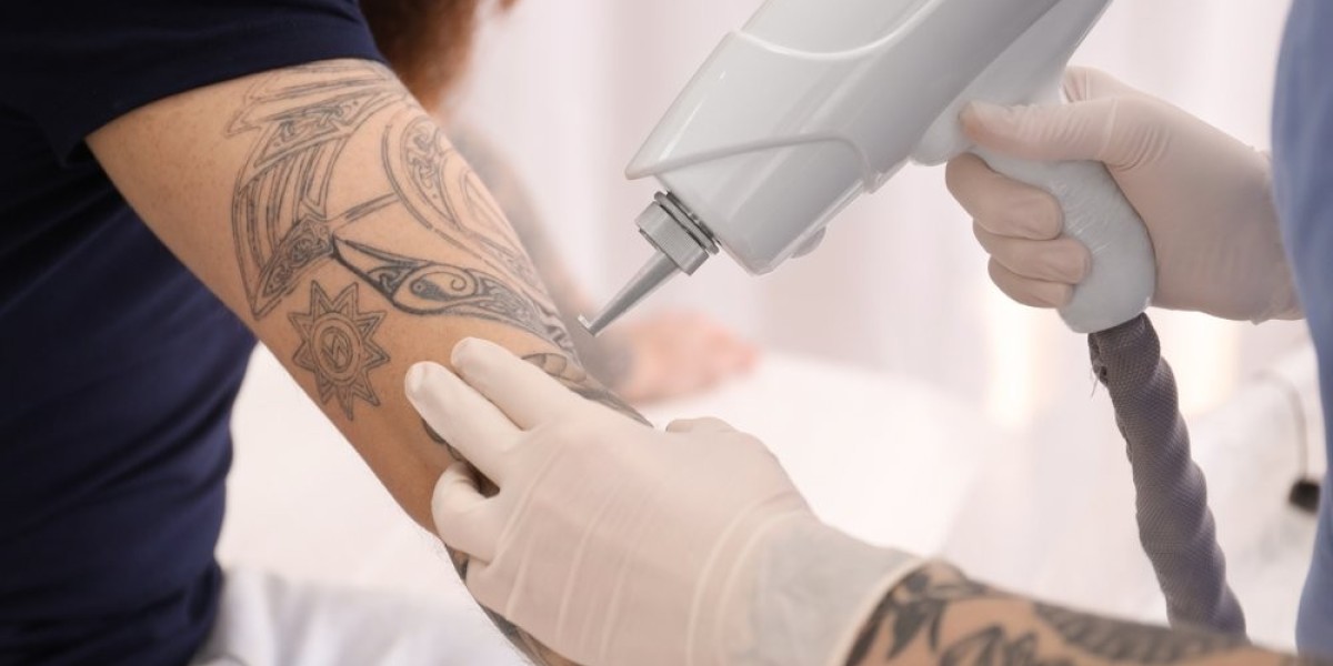 Effectiveness of Laser Tattoo Removal