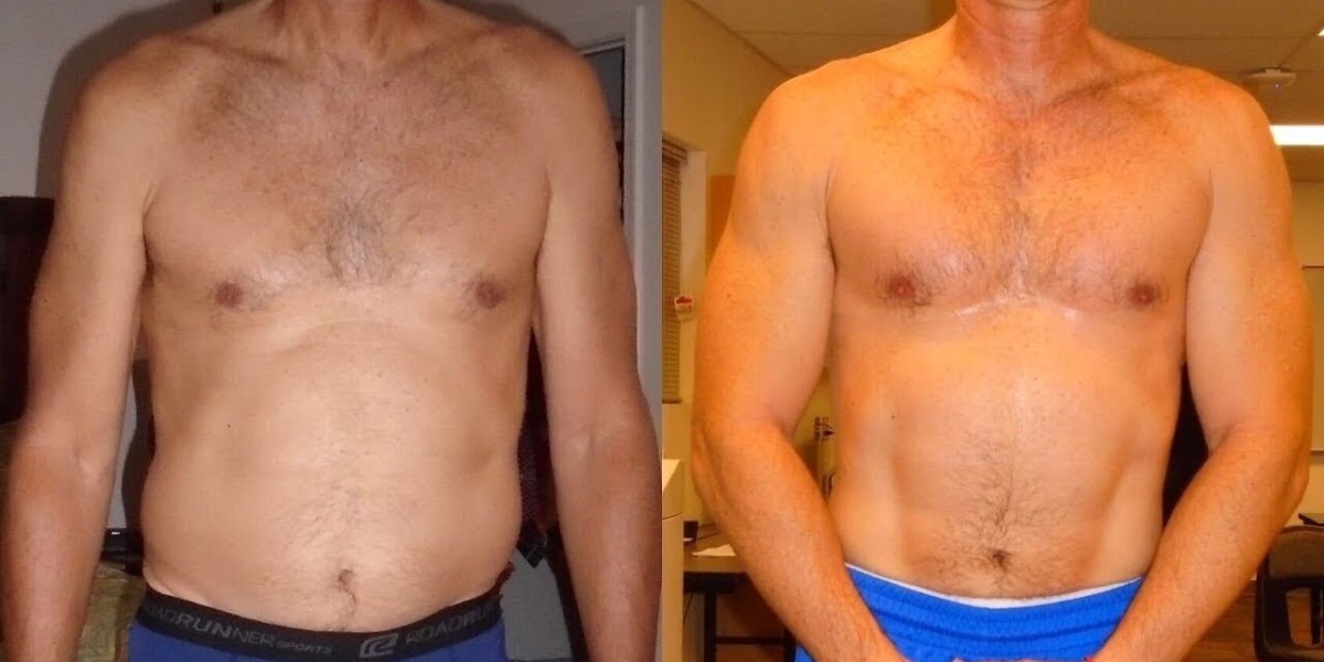 What to Expect After Tummy Tuck in Islamabad