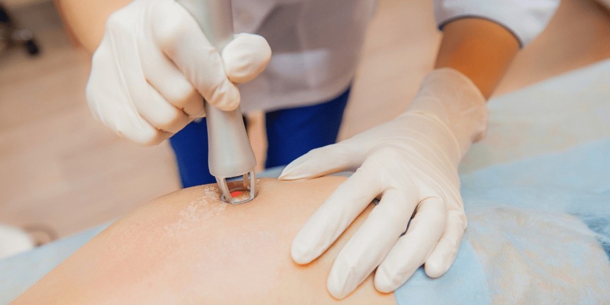 Who Should Try Laser Stretch Marks Treatment in