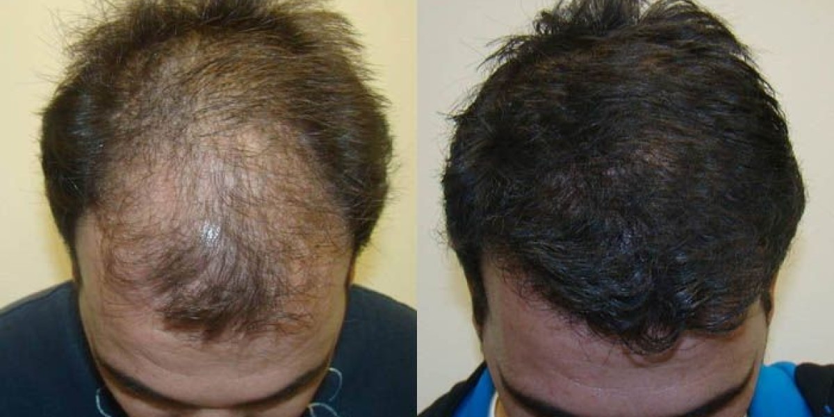 Fue hair tranplant in islamabad