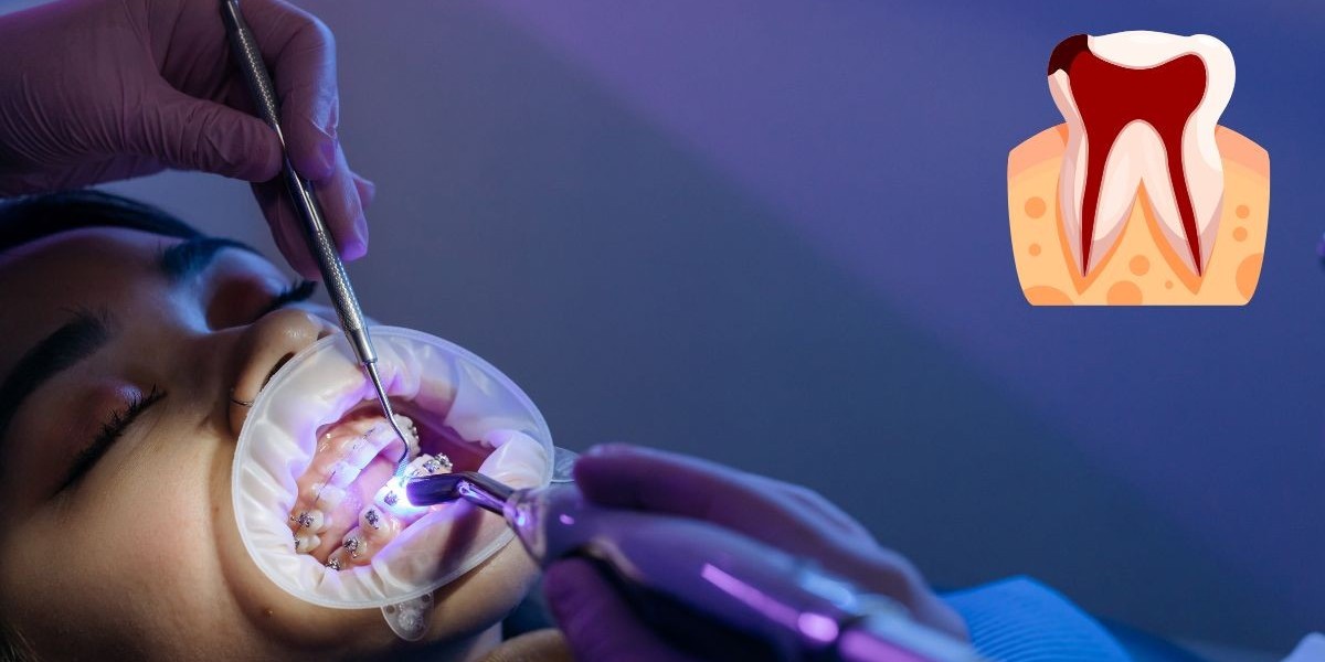 Root Canal Treatment in Dwarka, New Delhi