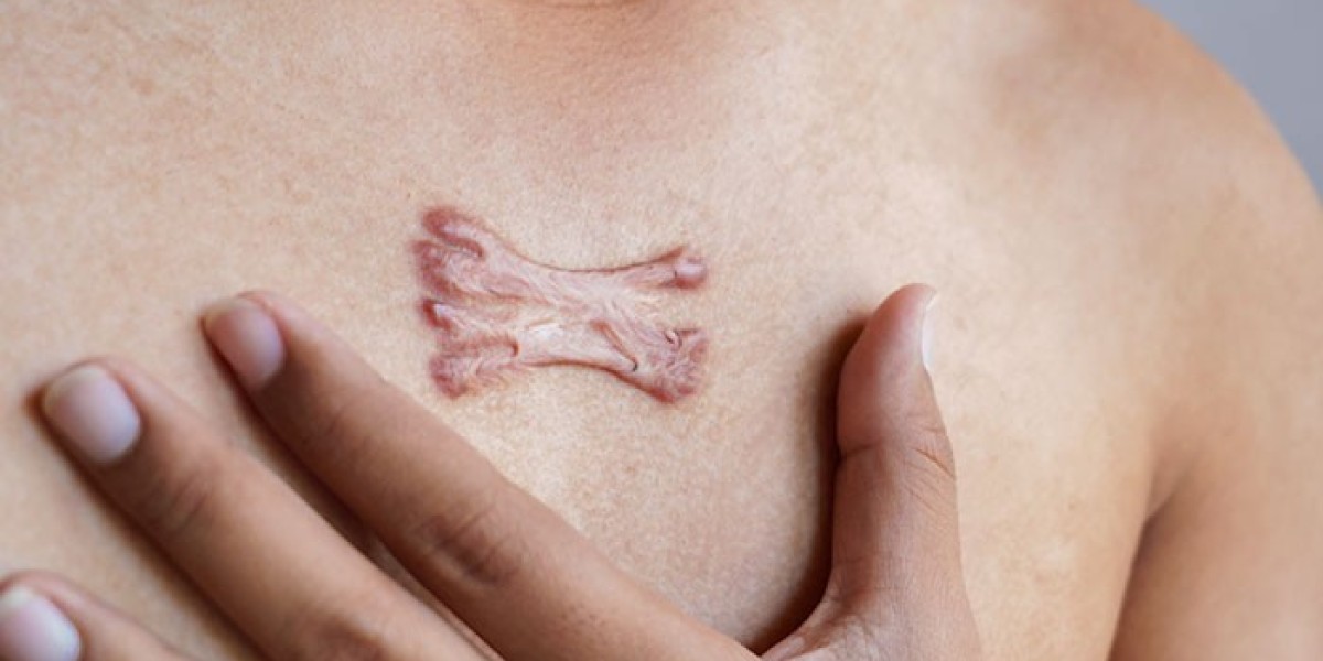 Are Keloid Injections Available in Islamabad?