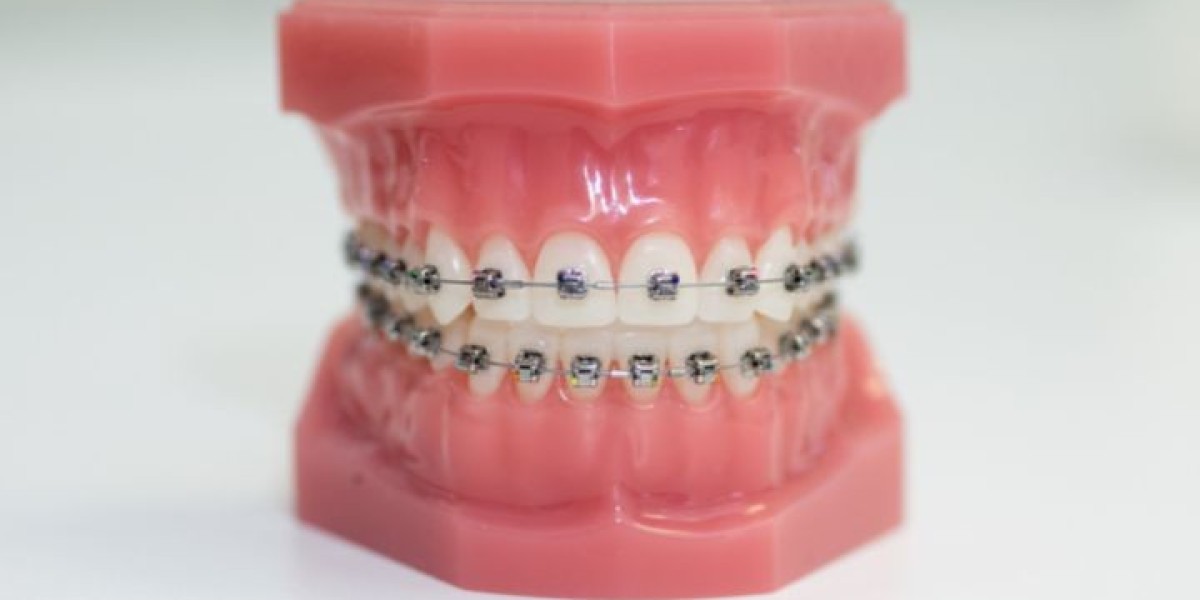 How Orthodontists Use Braces to Fix Crooked Tee