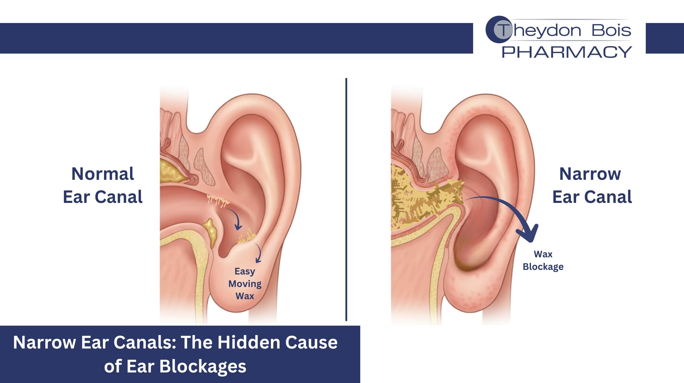 Narrow Ear Canals: The Hidden Cause of Ear Blockages