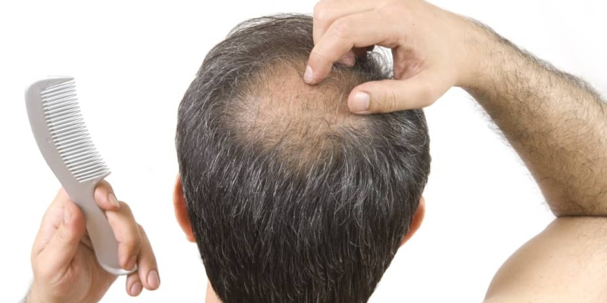 Hair Transplants in Dubai: What to Expect