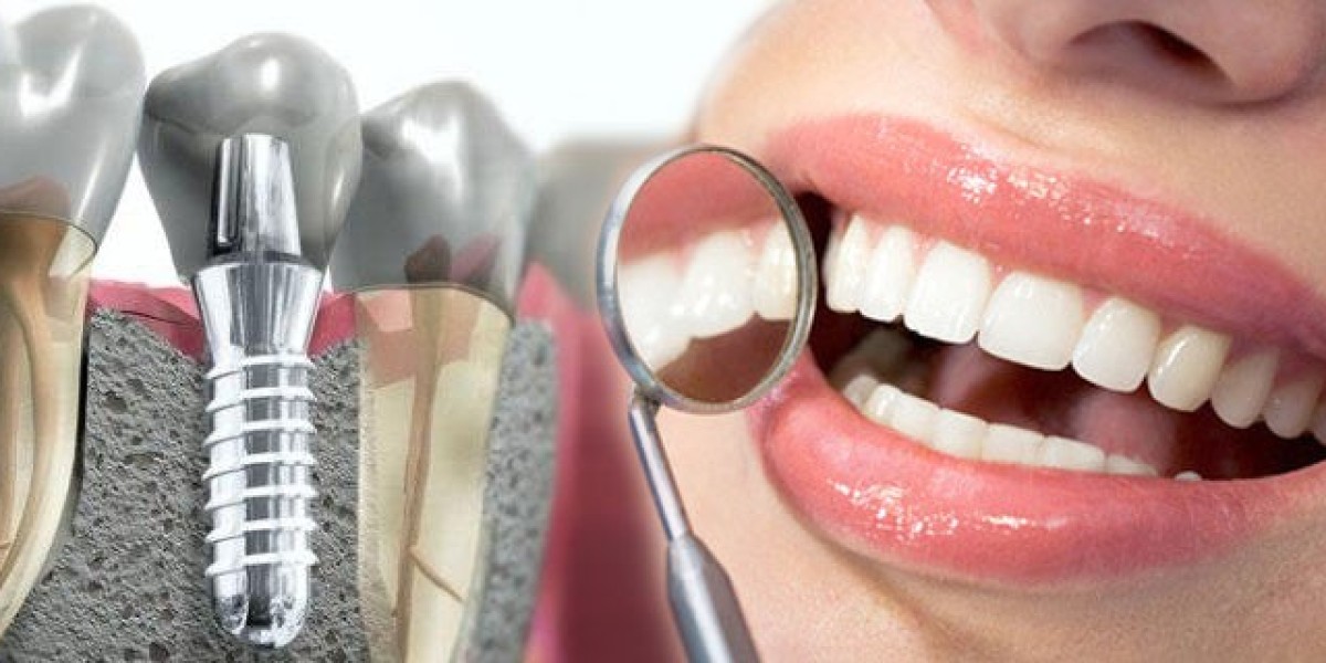 Why Dental Implants Are Worth the Investment