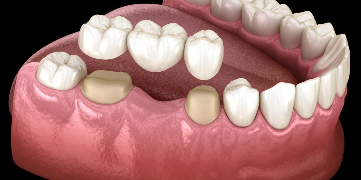Replace Missing Teeth with Bridges