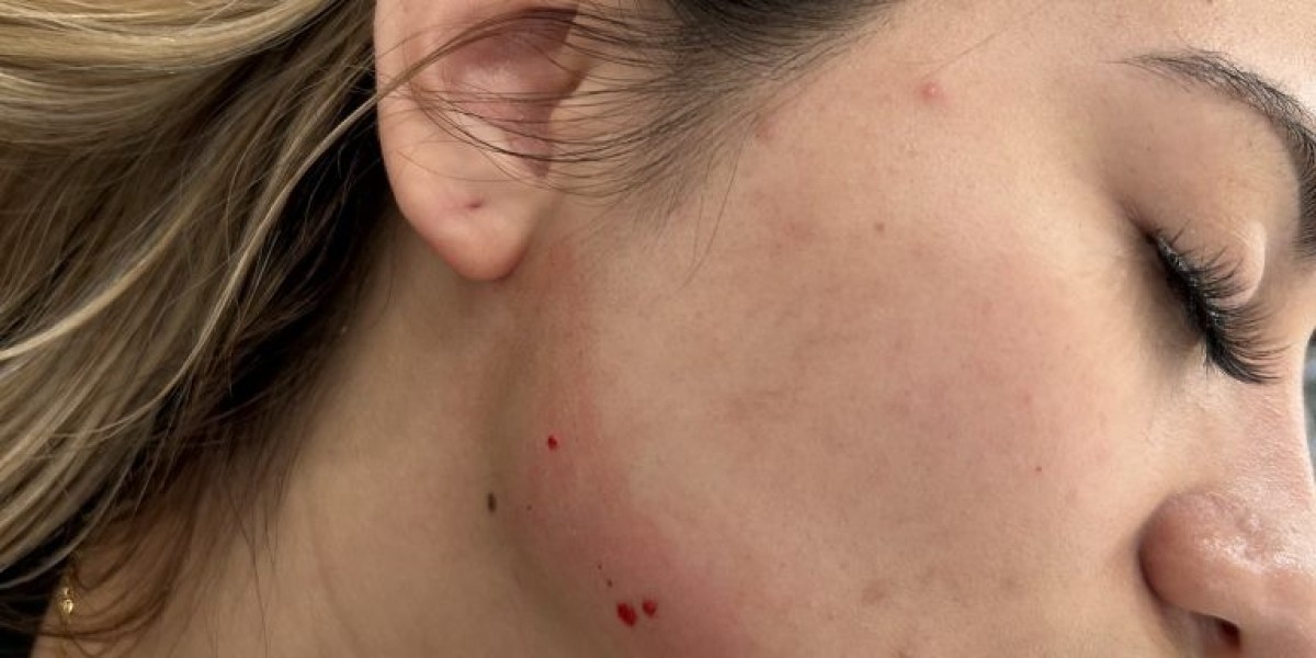 Rediscover Youthful Contours with Dermal Filler