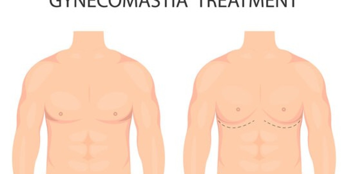 Minimally invasive gynecomastia surgery