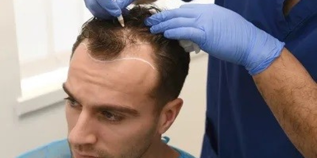Hair Transplant: Tips for Choosing Right Clinic