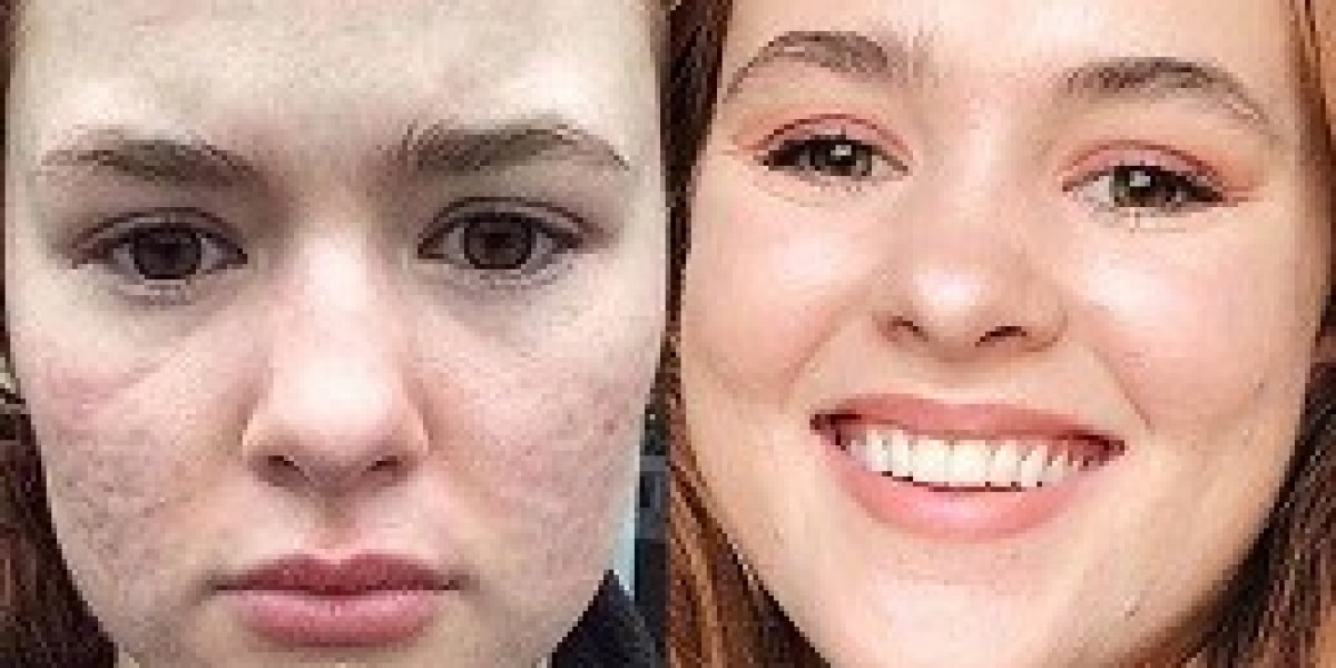 How do you know which acne scar treatment in Du