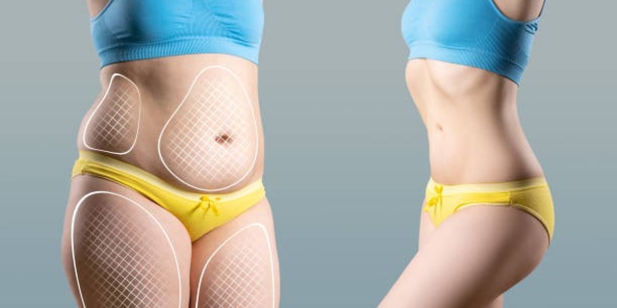 Transform Your Body with Expert Liposuction in