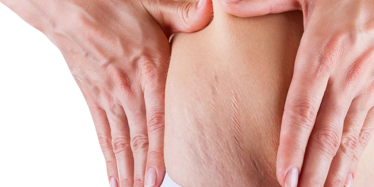 Why Choose Laser Stretch Marks Treatment in Dub