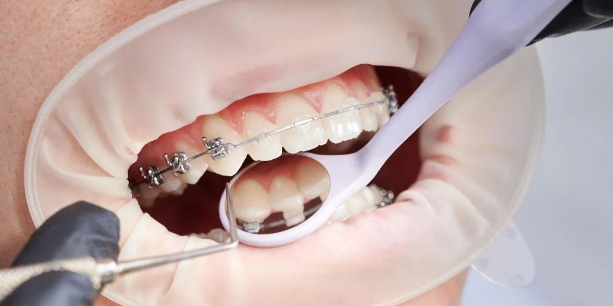 Dental Braces in Dubai: Before and After