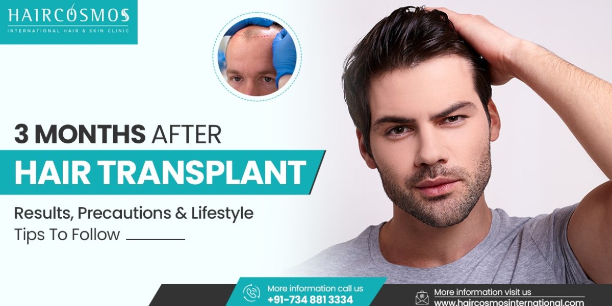 3 months after hair transplant