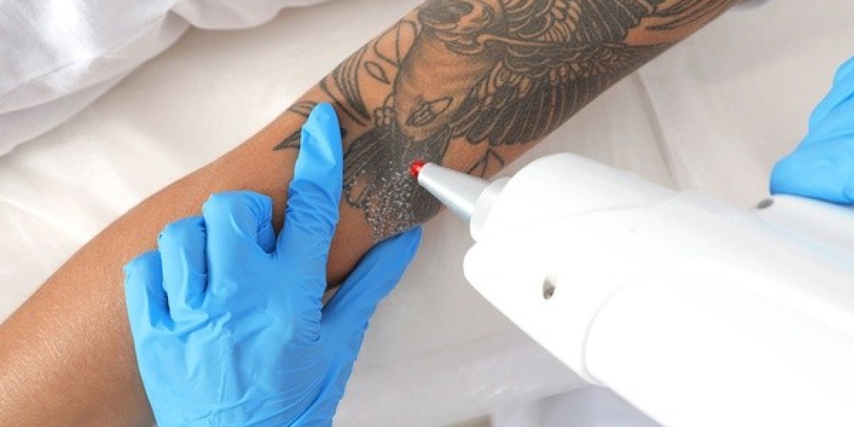 Best Laser Tattoo Removal Clinics Near You: