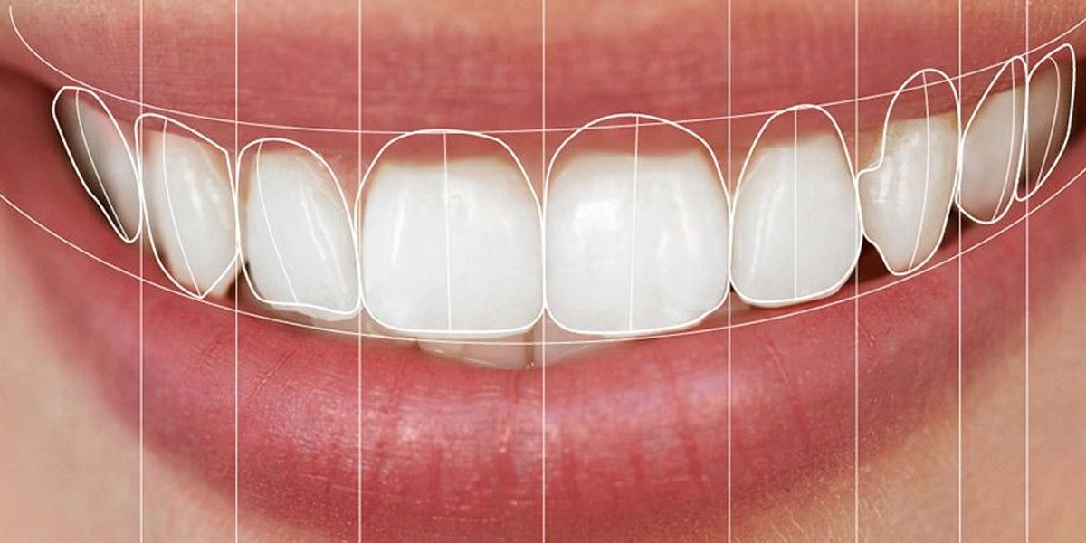 What Is Digital Smile Design?