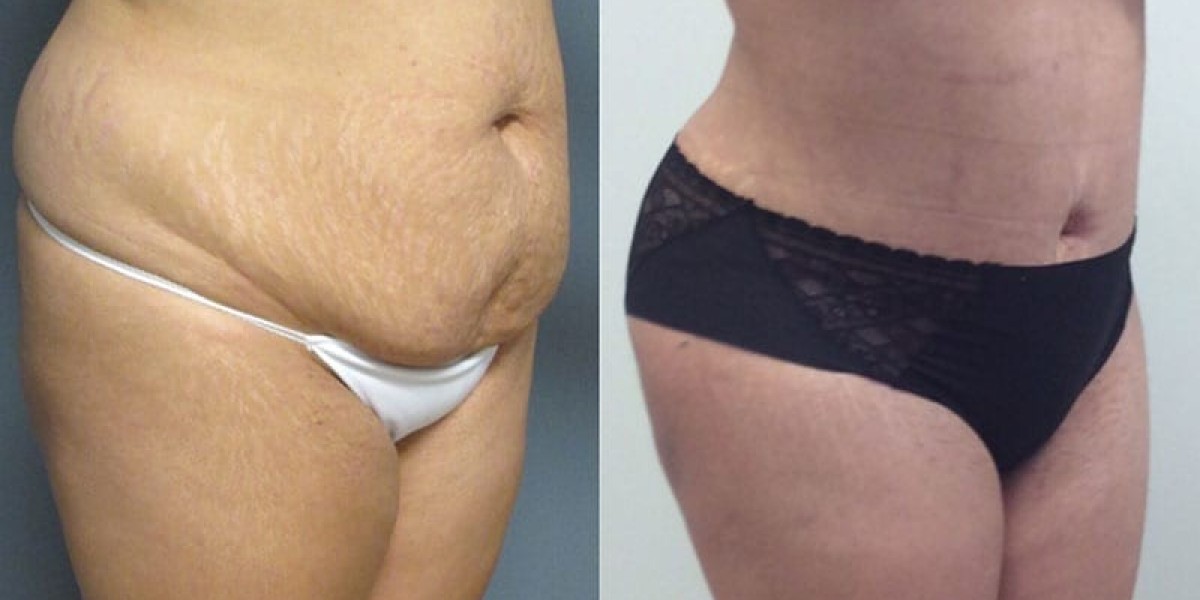 Top Abdominoplasty Packages in Islamabad