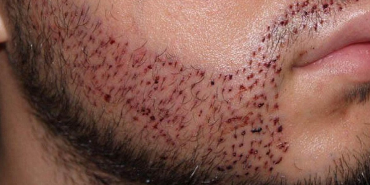 How Hair Transplants Can Boost Your Confidence