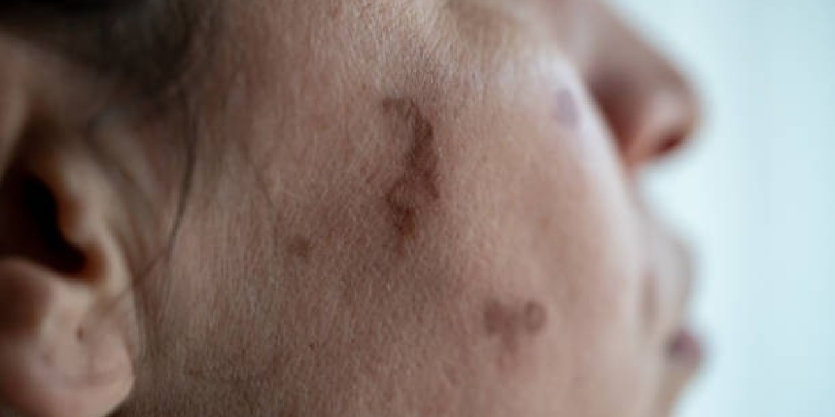 Birthmark Removal in Dubai: Clearer Skin Made P