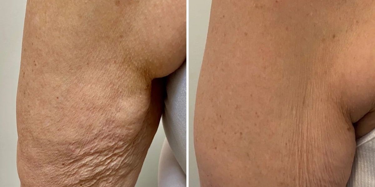 Non-Surgical Lipedema Management in Riyadh