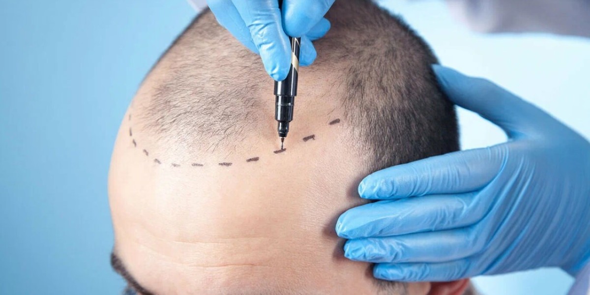 Comparing FUE and FUT: Which Is Best for You?