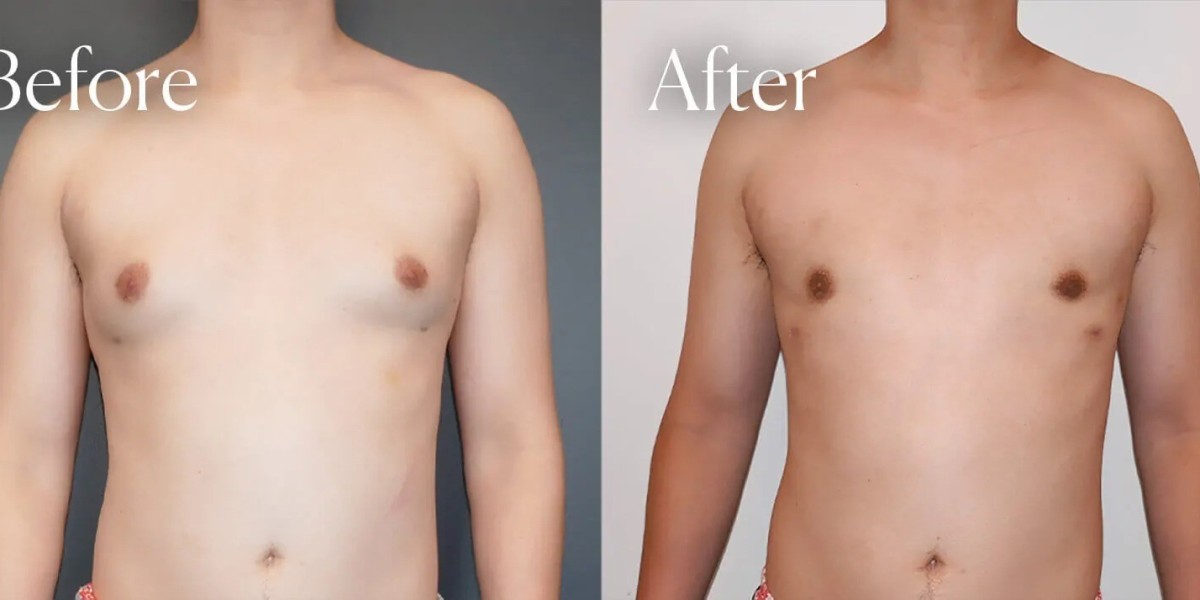 How Common Is Gynecomastia in Dubai?
