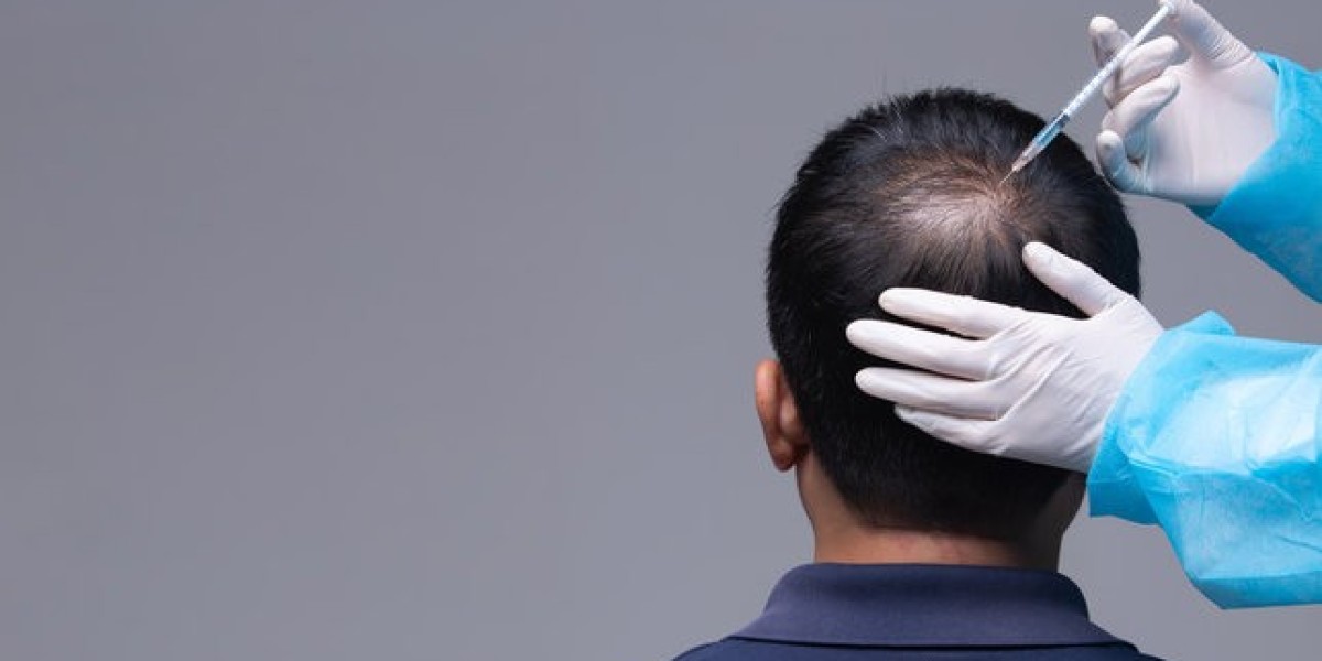 Non-Surgical Baldness Cure: Exosome Therapy Isl