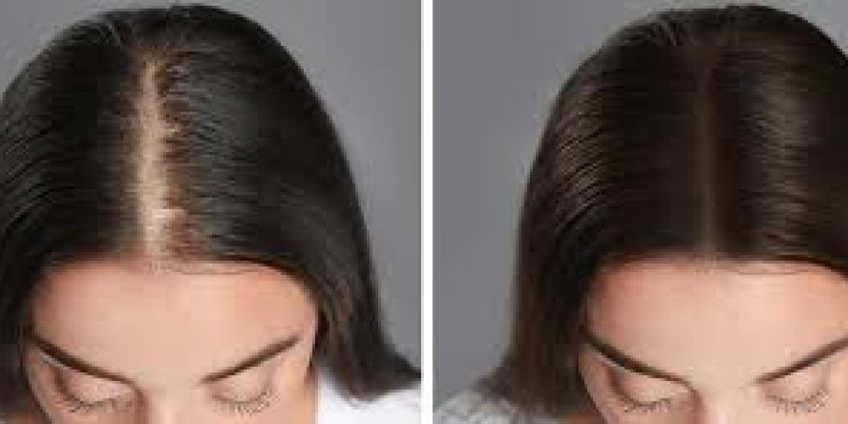 Hair Transplant Beverly Hills: Natural Results