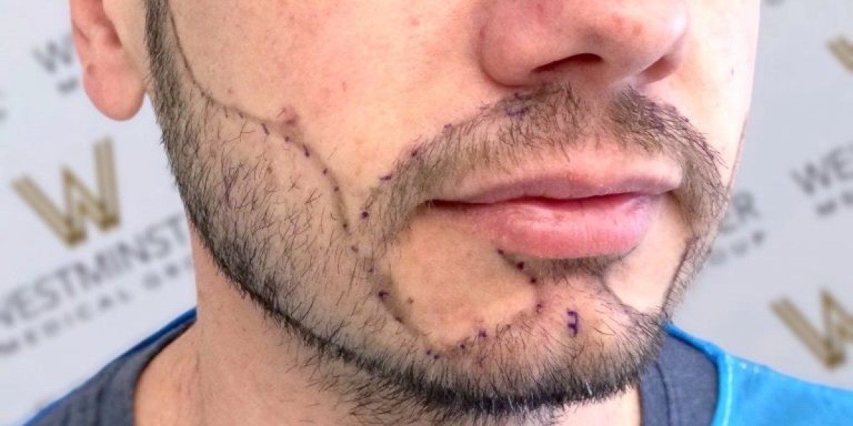FUE Beard Transplant London: Achieve a Fuller B