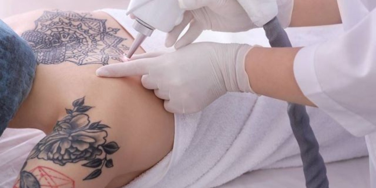 https://www.articlealley.com/news/laser-tattoo-