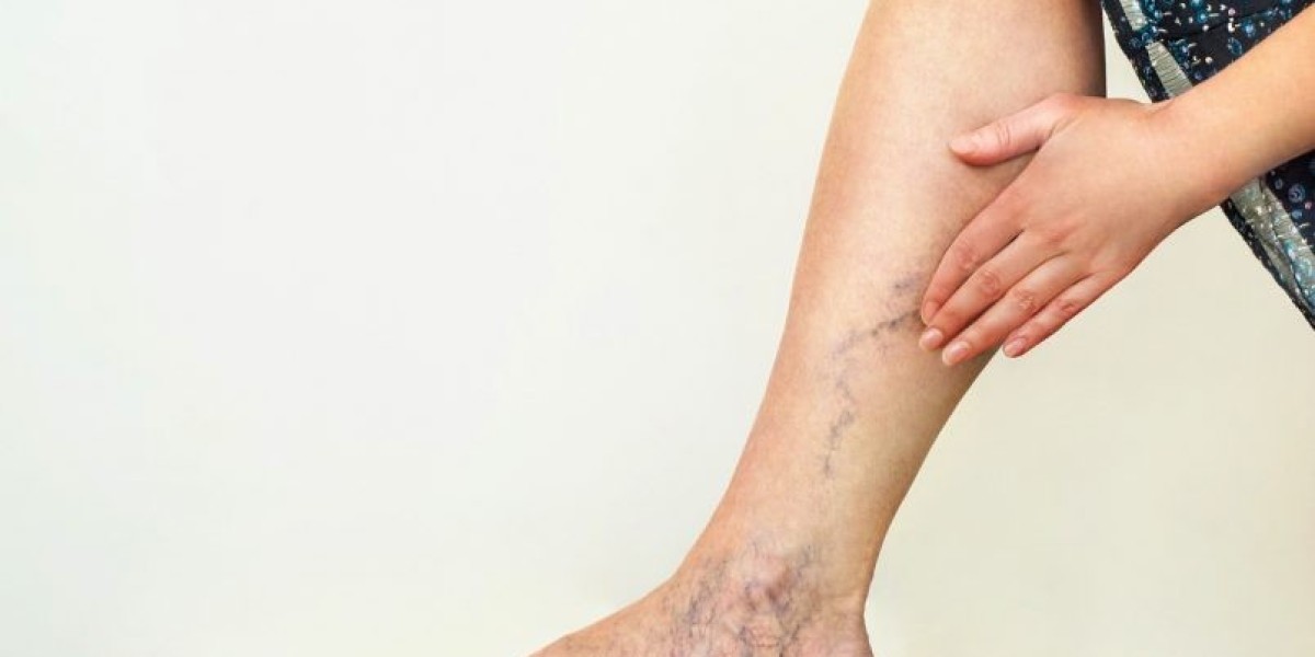 Sclerotherapy for Spider Veins in Islamabad