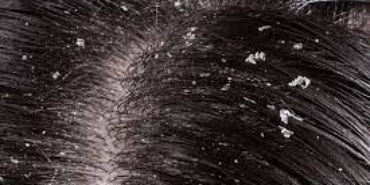 Natural Ayurvedic Dandruff Treatment in Dubai