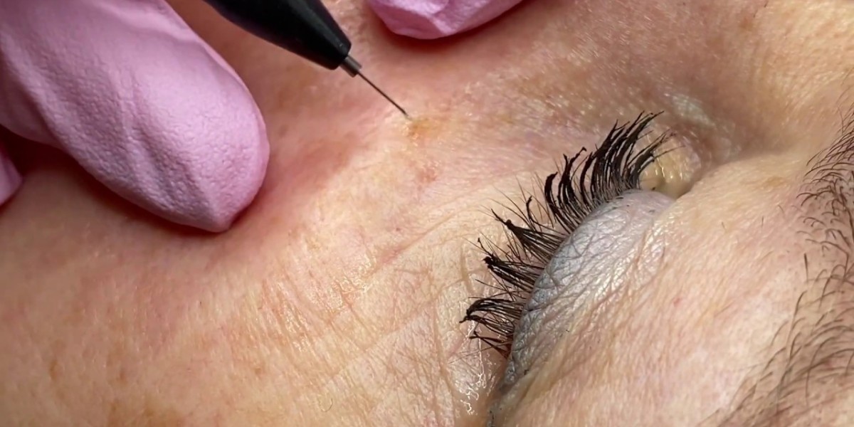 Why Does Skin Wart Removal Cost in Dubai Vary?