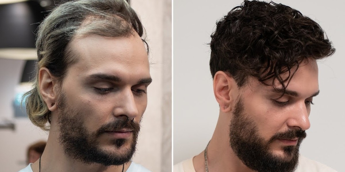 Advanced Hair Restoration in Los Angeles