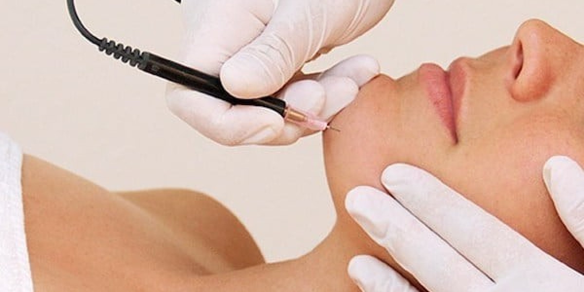 How many sessions of electrolysis do you need?