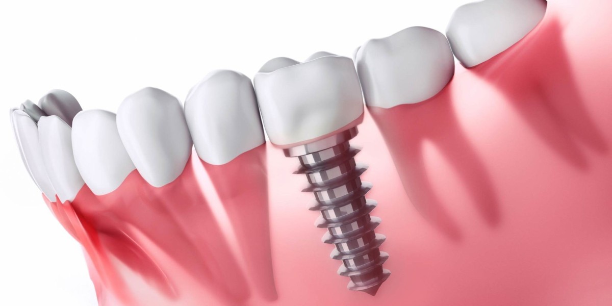 Single Tooth Implants Dubai: Procedures, Benefi
