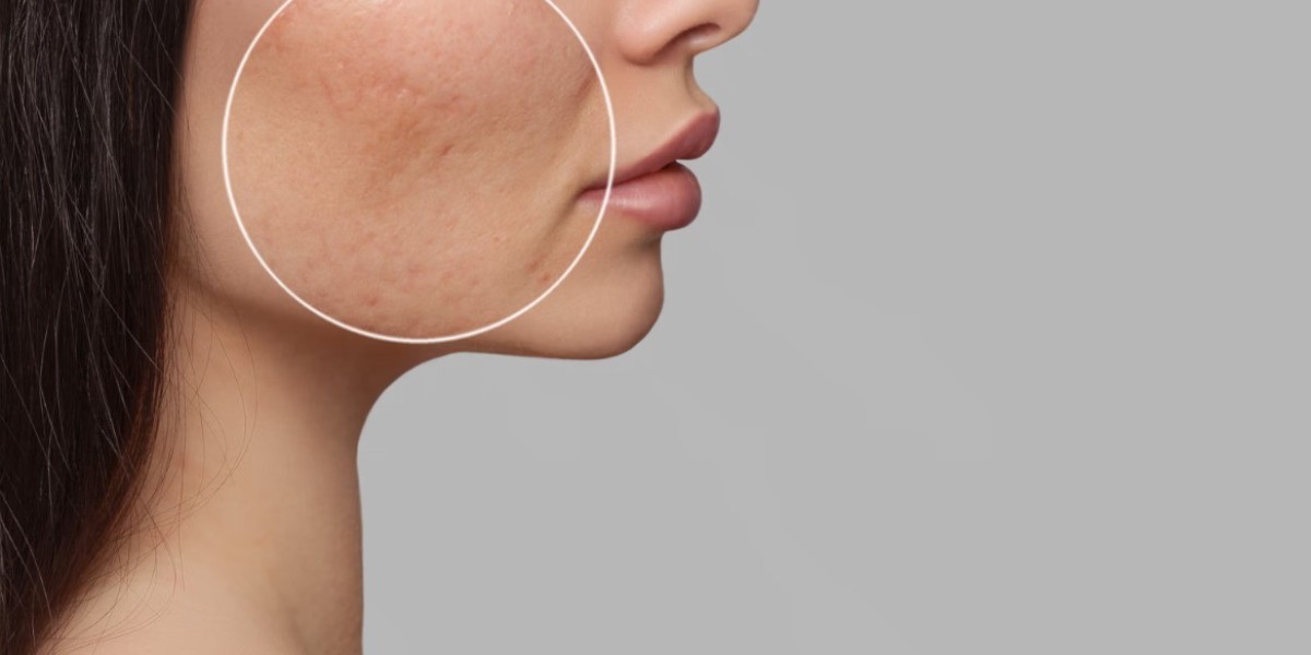 Top Methods for Acne Scar Reduction