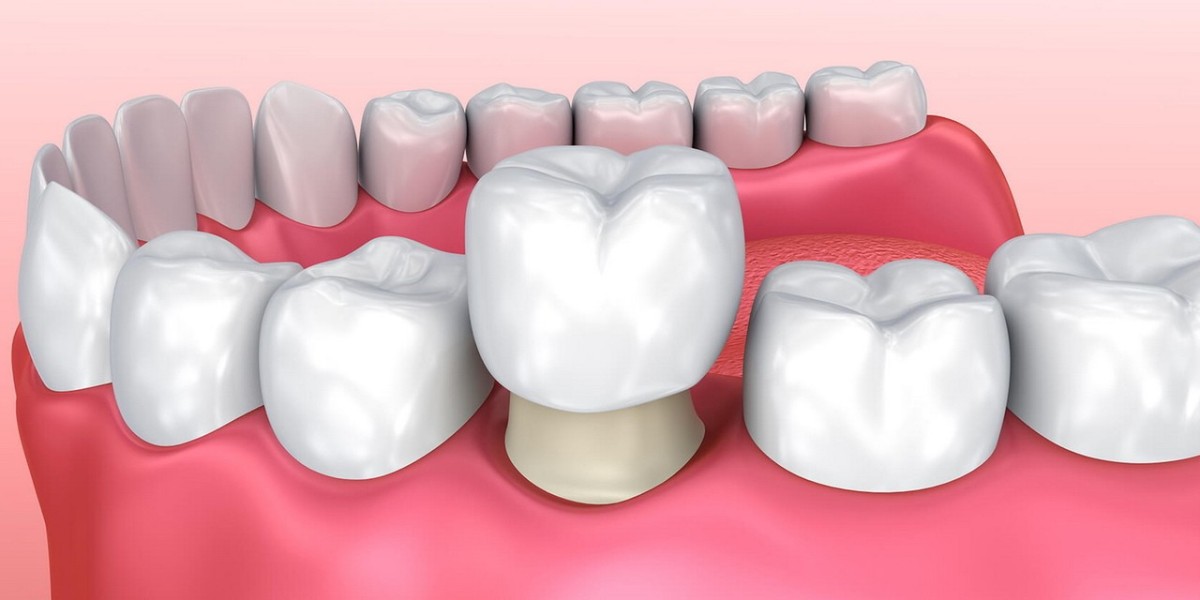 The Cost of Dental Crowns in Islamabad