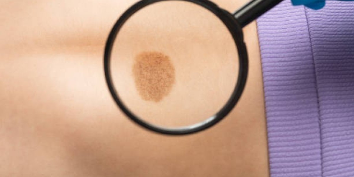 Birthmark Removal Dubai: Safe & Effective Laser