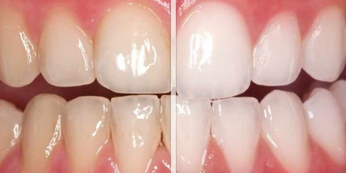 Teeth Whitening in Dubai: Boost Your Confidence