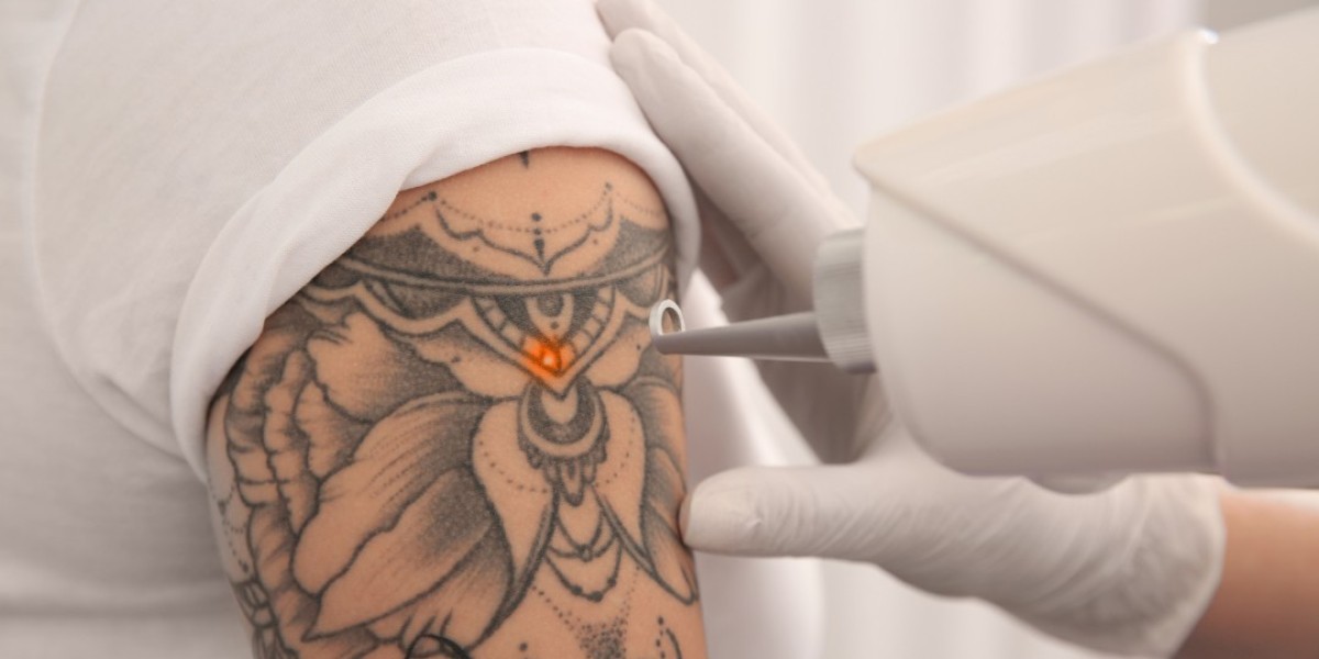 What to Expect After Each Laser Tattoo Removal