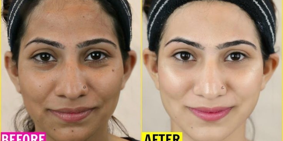 Skin Whitening Solutions in Islamabad