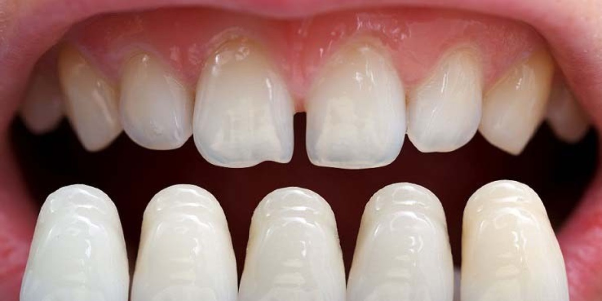 How Composite Veneers Can Change the Way You Se