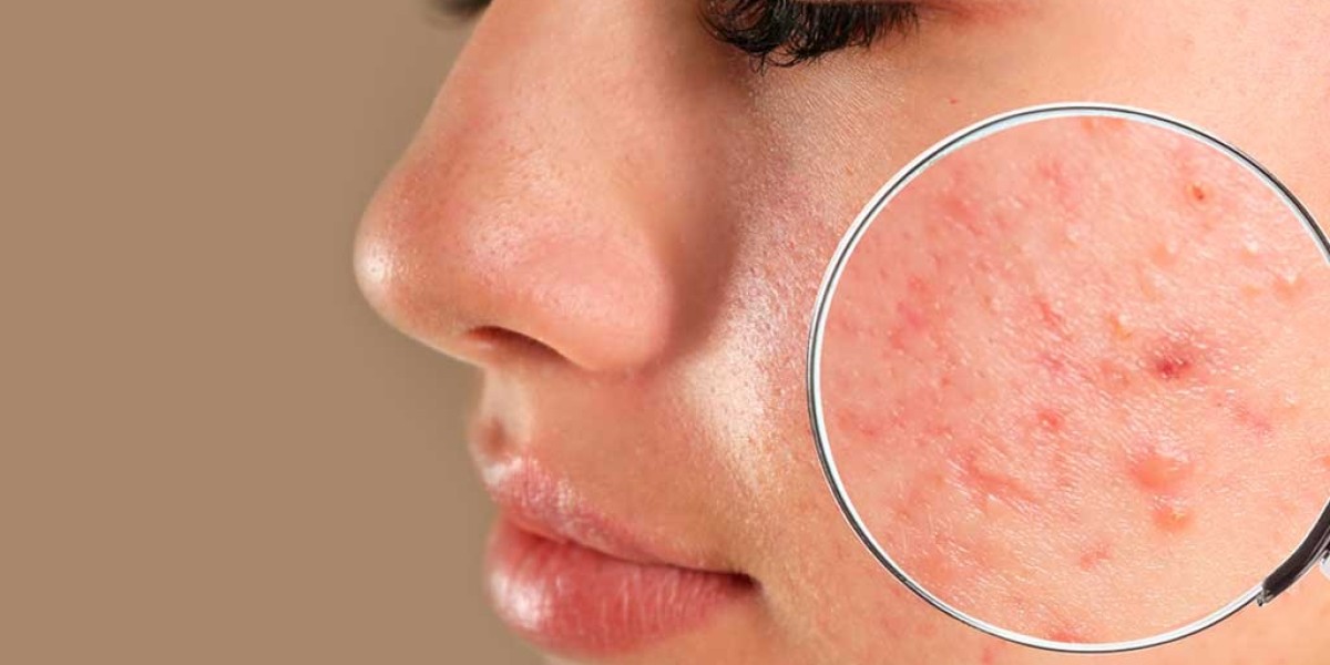 Pimples Treatment Dubai: Effective Acne Care!