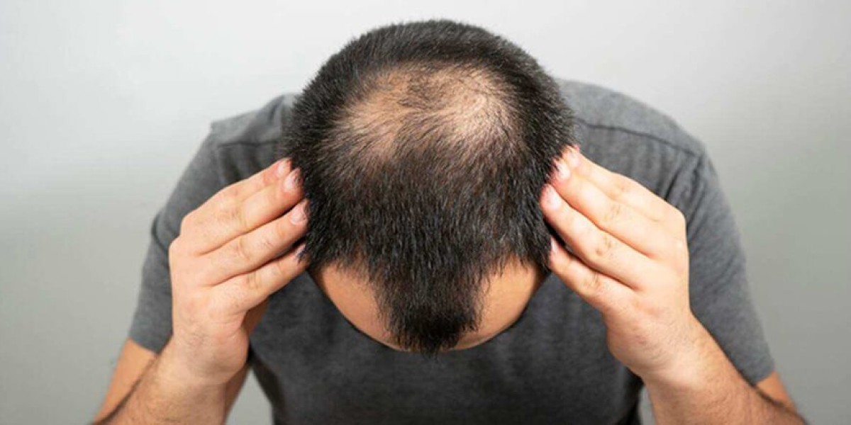Hair Transplantation Dubai: Latest AI-Assisted