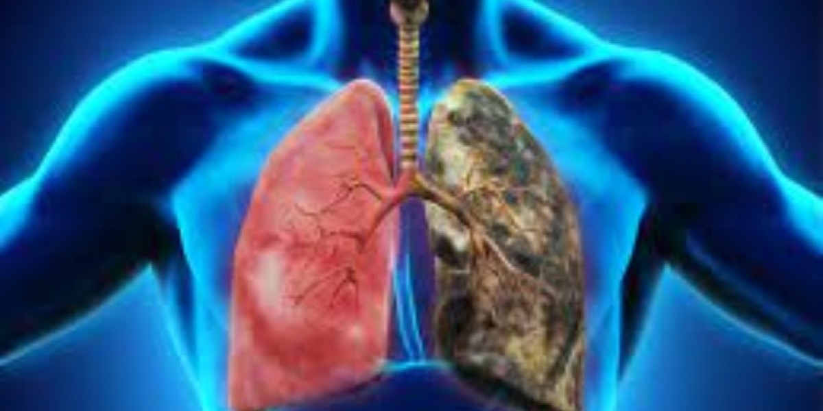 Lung Cancer Screening - Best Writes