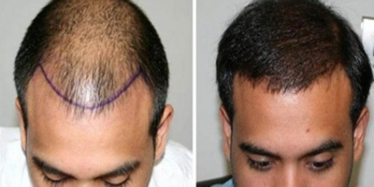 زراعة الشعر للرجال في دبي: كل ما تريد معرفته